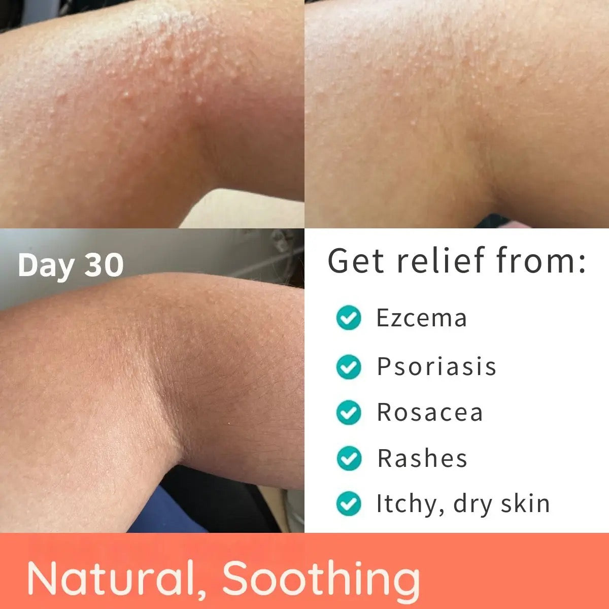Natural Manuka Honey Balm - For Eczema, Sensitive and Dry Skin, 2-4oz, YoRo Naturals
